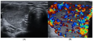 Darstellung eines Ultraschall mit und ohne Doppler Sonographie. Es wird das "wildfire" Phänomen bei Morbus Basedow dargestellt